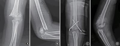 Bridging Myositis Ossificans After Supracondylar Humeral Fracture in a Child: A Case Report